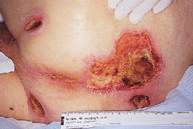 ulcera [http://hab.hrsa.gov/tools/palliative/images/P25-5.gif]