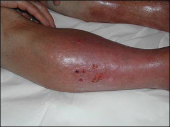 lesione vascolare [http://www.cavezzi.it/Bernardini_file/slide0006_image026.jpg]